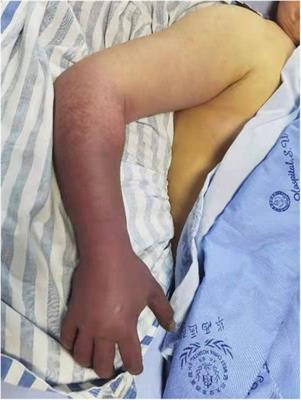 Upper extremity phlegmasia cerulea dolens complicating supra vena cava embolism in a cervical cancer patient: case report